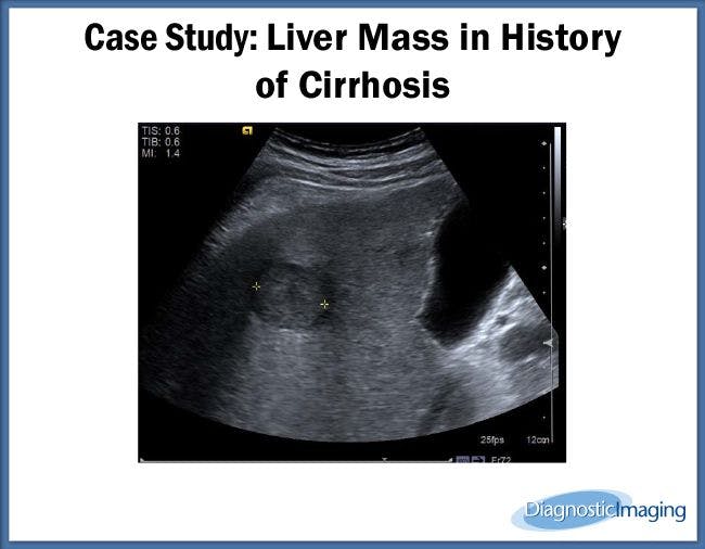 Liver Mass in History of Cirrhosis