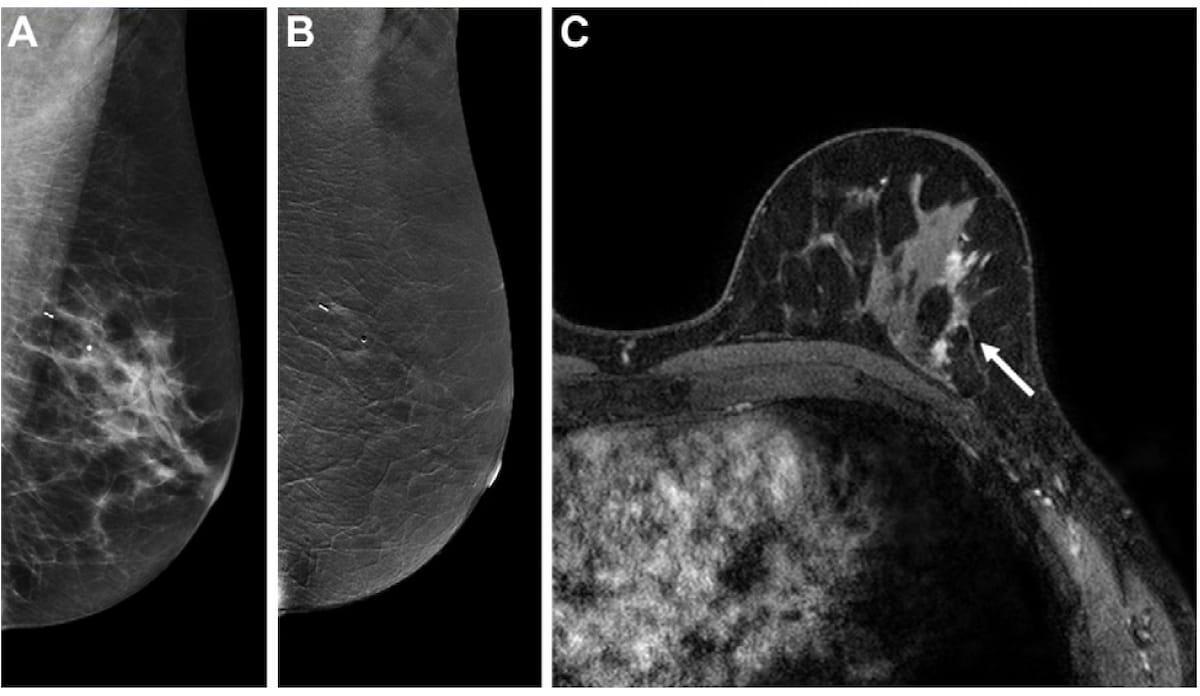 Study Reveals Tradeoffs Between Contrast-Enhanced Mammography and MRI for Supplemental Screening