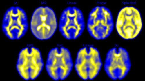 Imaging Shows Brain Changes in High School Football Players