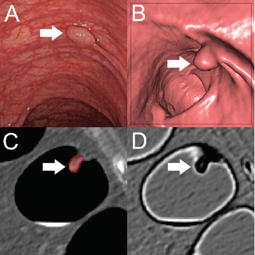 A, Optical colonoscopy and, B–D, CT colonography of a 9-mm polyp (arrow) in the descending colon of a 78-year-old woman. B, Virtual fly-through three-dimensional reconstructions were used for exact polyp localization. C, Manual polyp segmentation was performed in multiplanar two-dimensional CT colonography images. D, CT colonography images were preprocessed for image feature extraction by application of a dedicated filter.

Courtesy: RSNA