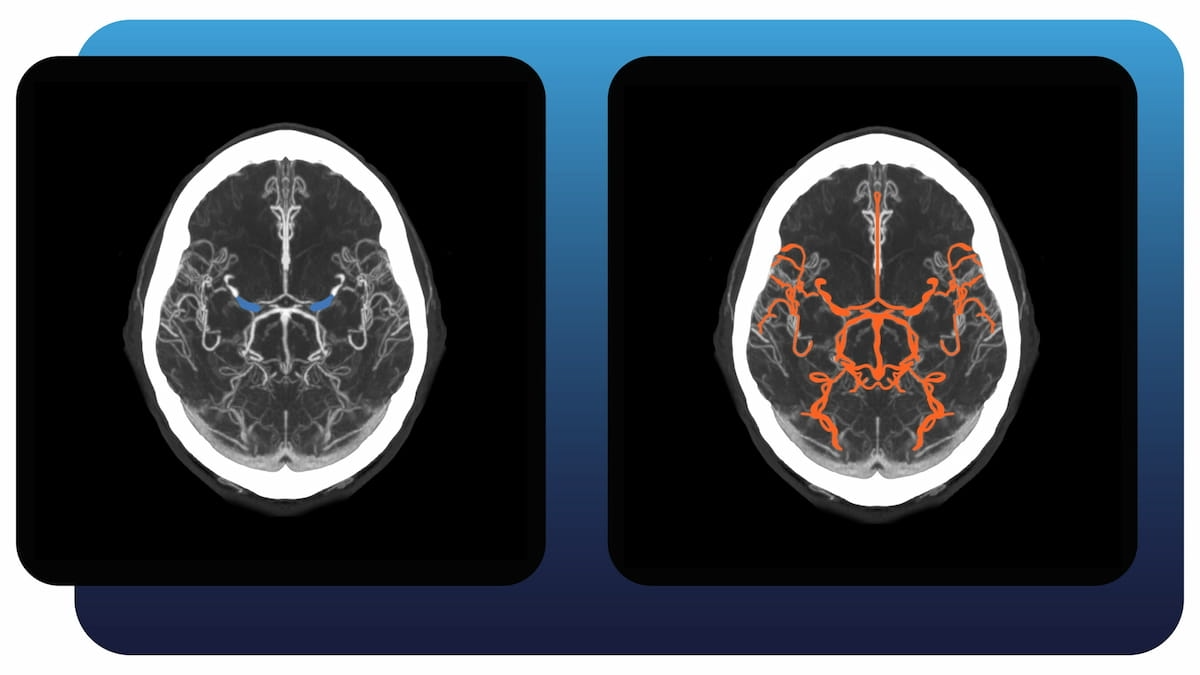 Aidoc Launches AI-Powered Neuroimaging Software for Vessel Occlusion Detection on CT