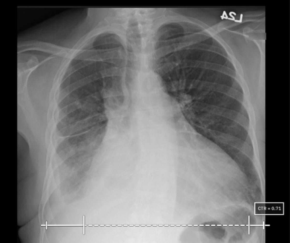 FDA Clears AI-Powered Cardiothoracic Ratio Assessment for Chest X-Rays