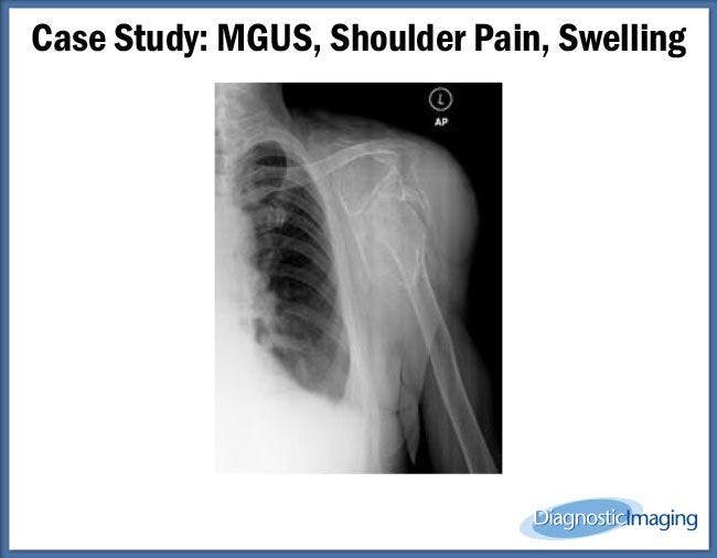 MGUS, Shoulder Pain, Swelling
