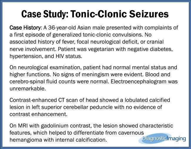 Tonic-Clonic Seizures