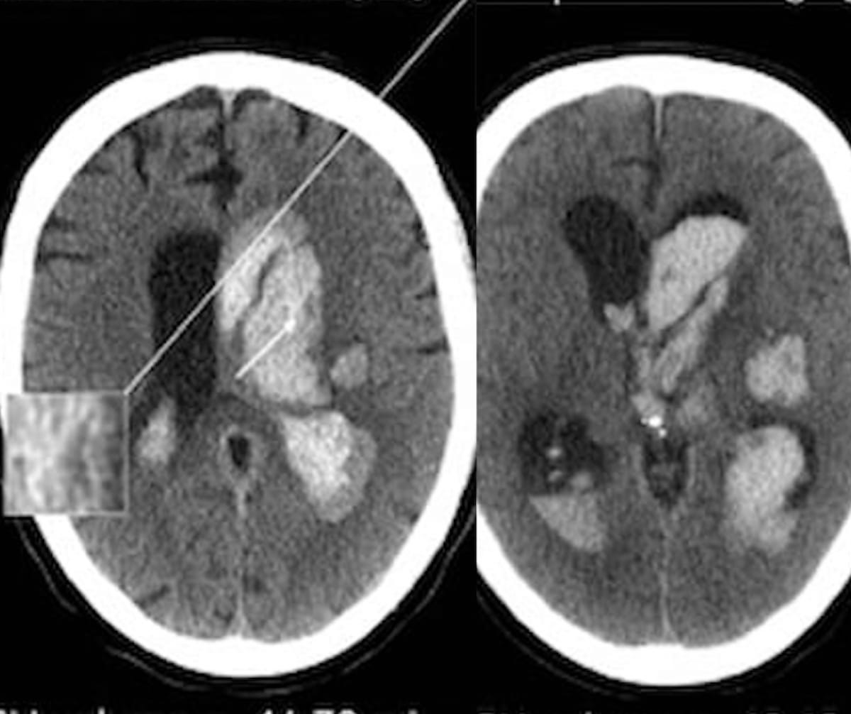 Key Findings on Non-Contrast CT Signal Higher Complication Risks in Patients with Intracerebral Hemorrhage