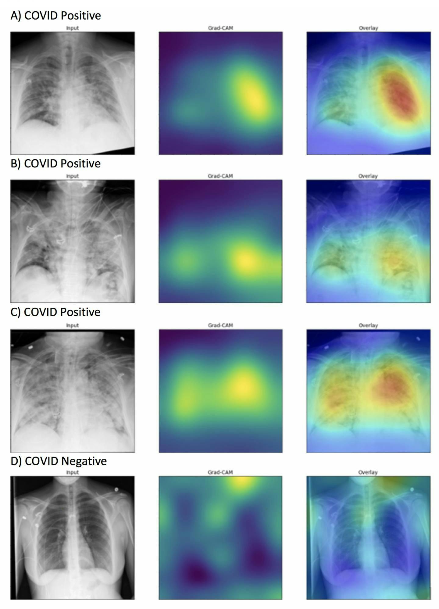 AI Algorithm Faster, More Accurate in Detecting COVID-19 on Chest X-rays