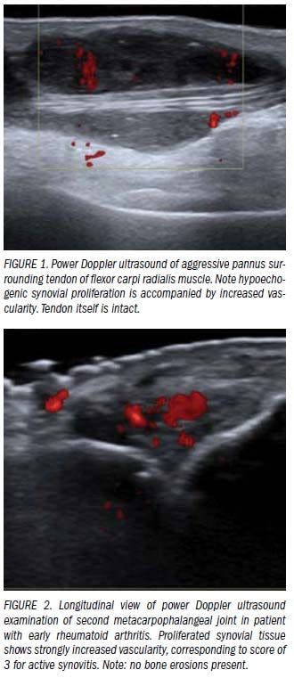 Modern ultrasound methods yield stronger arthritis work-up