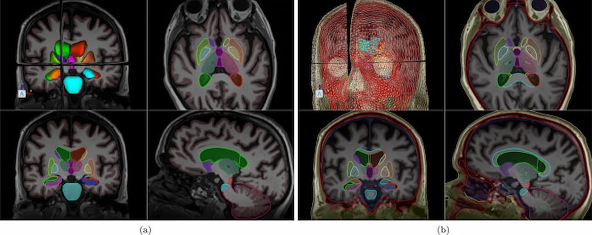FDA Clears New Version of AI Segmentation Software for Brain MRI