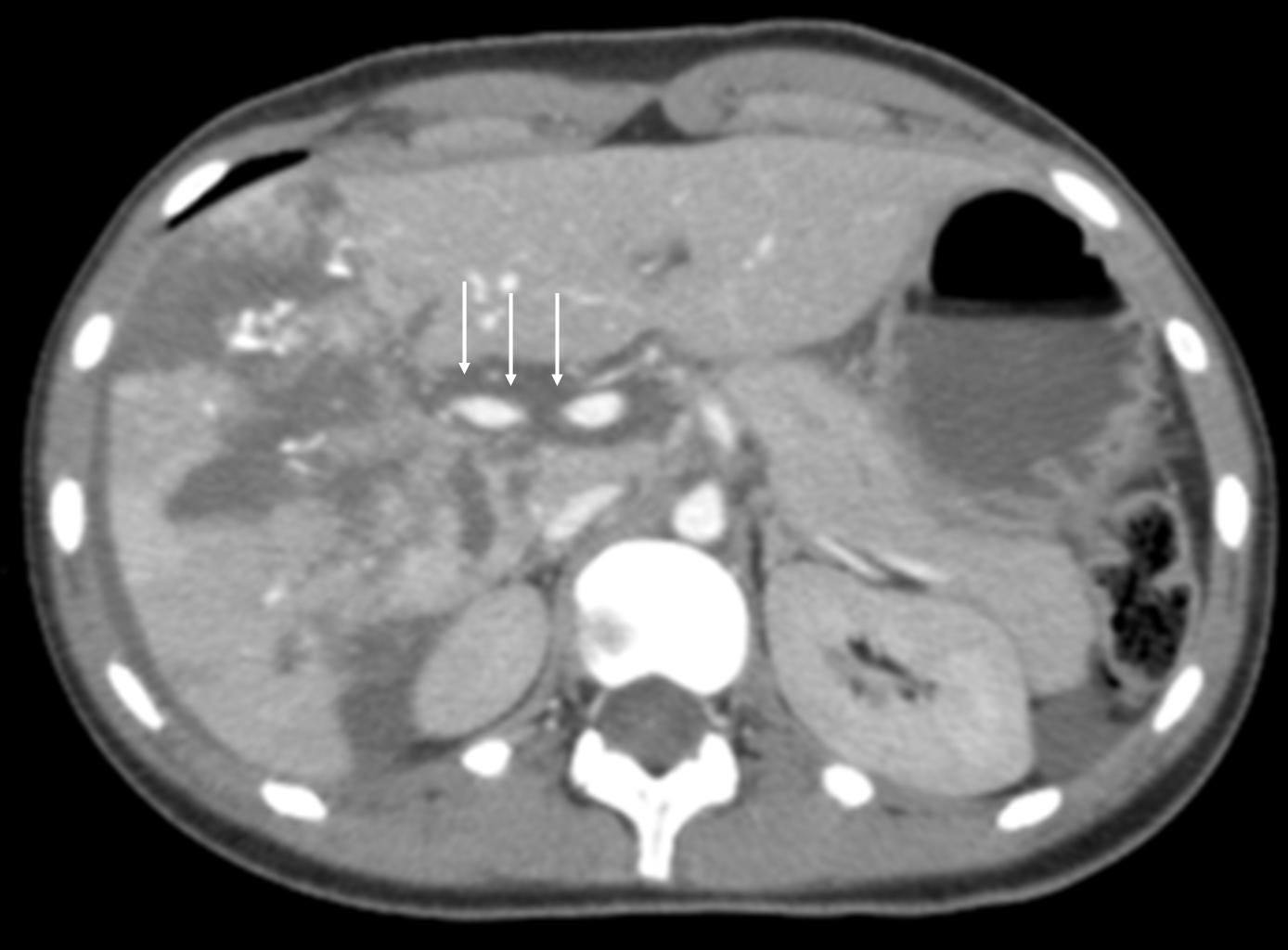 Effective use of abdominal CT can save lives in emergency setting
