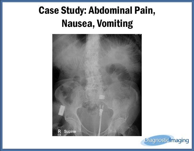 Abdominal Pain,  Nausea, Vomiting