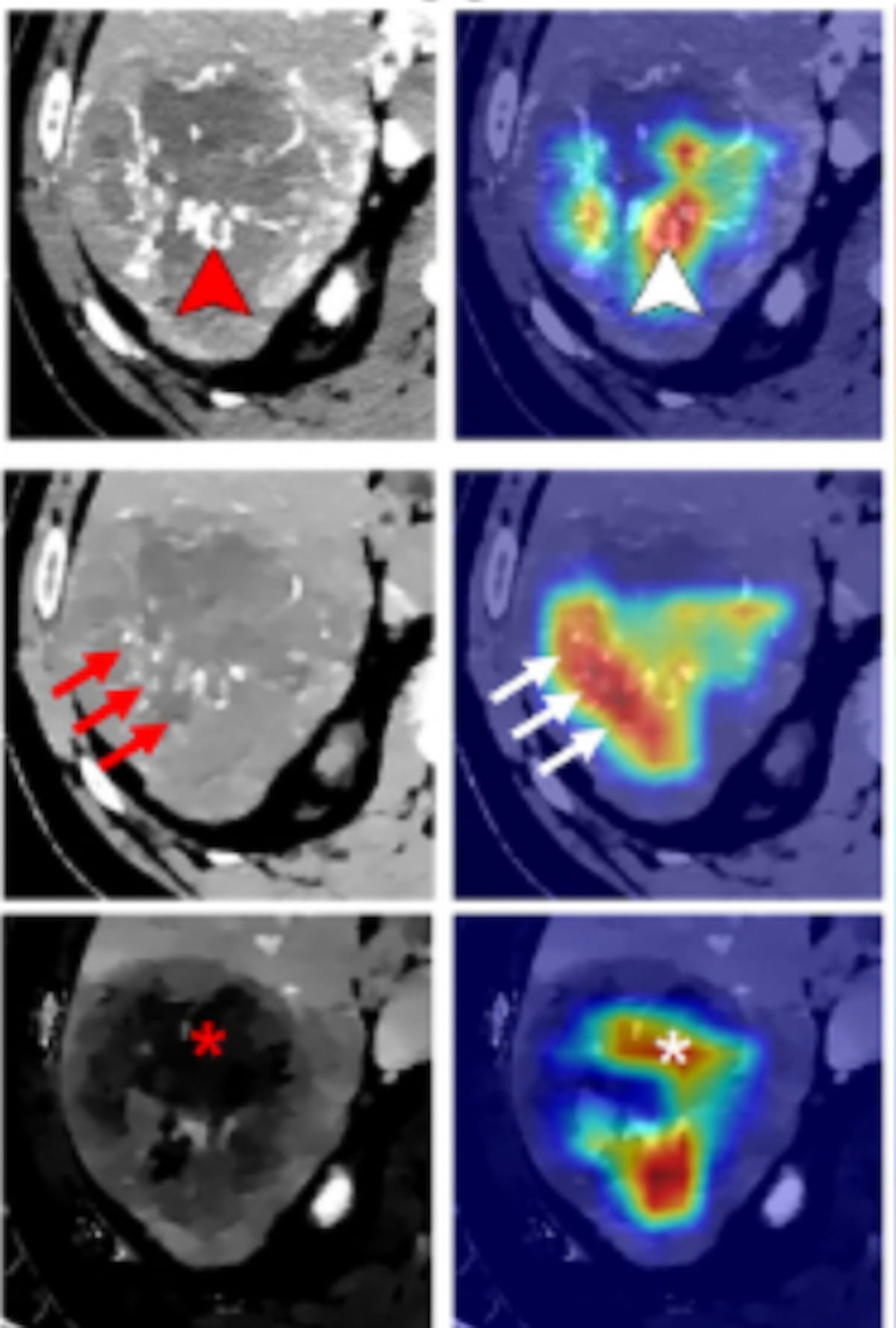 Can Dual-Energy CT Radiomics Improve Risk Assessment for Macrotrabecular-Massive Hepatocellular Carcinoma?