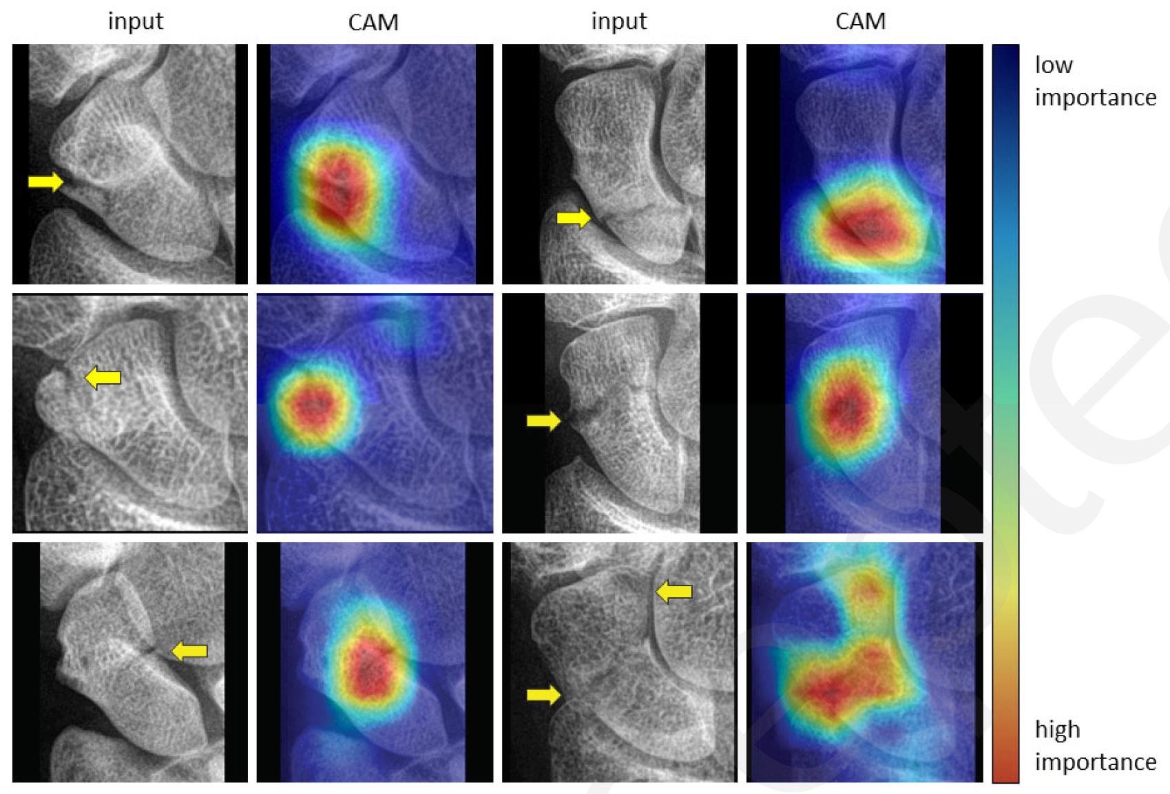 Examples of class activation map (CAM) for localizing fractures. The interpretation of the CMAs follows from the color coding of a heat map, in which pixel regions with a warm color signify a greater influence on the final decision of the network than regions with a cold color. The yellow arrows projected on the input images indicate the fracture lines, and they are only shown for reference.

Credit: RSNA
