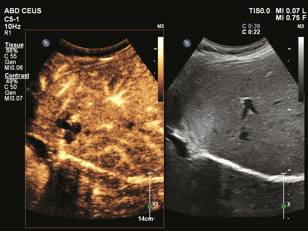 Philips Unveils New Contrast-Enhanced Ultrasound Application for EPIQ Elite Device