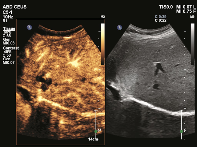 Philips Unveils New Contrast-Enhanced Ultrasound Application for EPIQ Elite Device