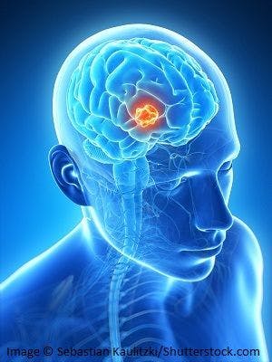 Brain Tumor Incidence Higher Following Childhood CT Scans