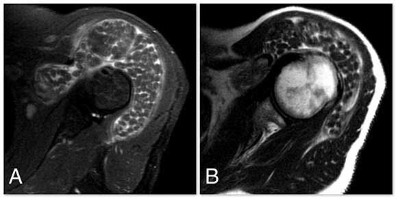 Synovial Osteochondromatosis of Subacromial Bursa