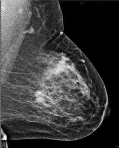 Invasive Mammary Carcinoma