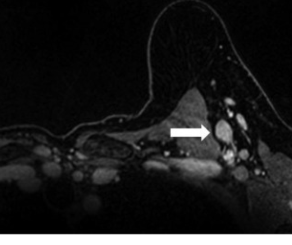 What a Breast MRI Study Reveals About Axillary Lymph Nodes and COVID-19 Booster Vaccination