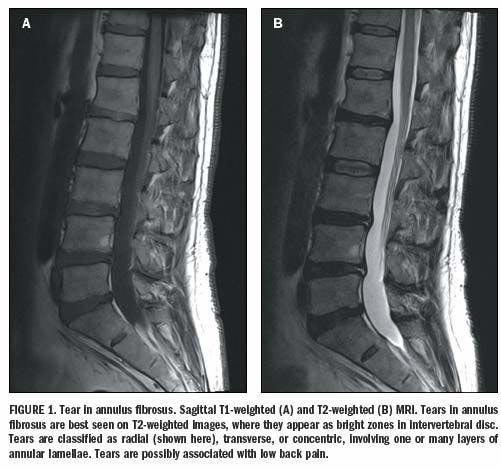 Correct application of MRI finds causes of low back pain