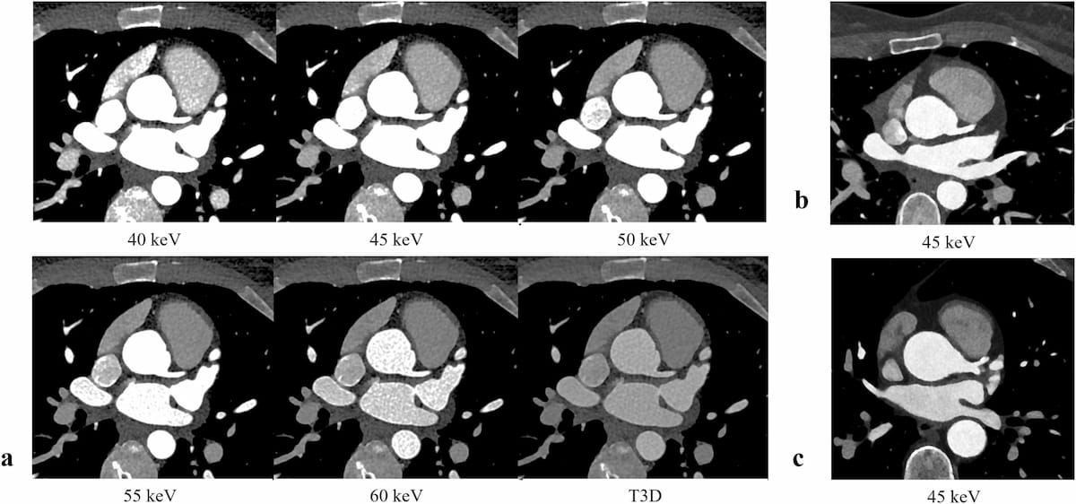 Emerging Concepts with ICM Reduction and Photon Counting for Coronary CT Angiography