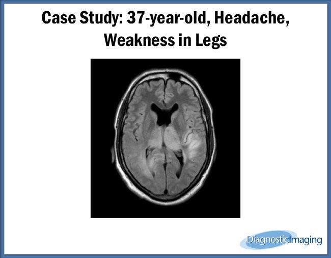 37-year-old, Headache, Weakness in Legs