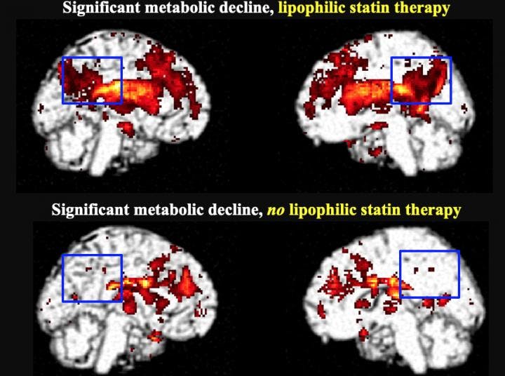 Significant metabolic decline in the posterior cingulate cortex in lipophilic statin users after five to six years (top) compared to hydrophilic statin users and non-statin users (bottom).

Credit: Image created by Prasanna Padmanabham and Daniel Silverman, UCLA


