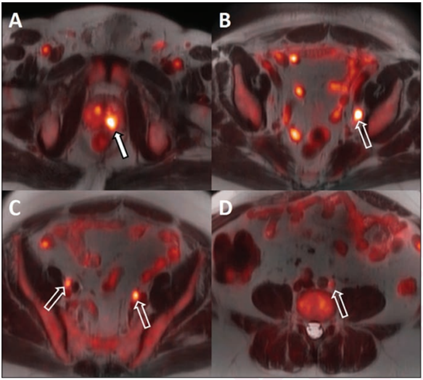 PET/MRI Boosts Prostate Cancer Staging and Hormone Therapy Evaluation