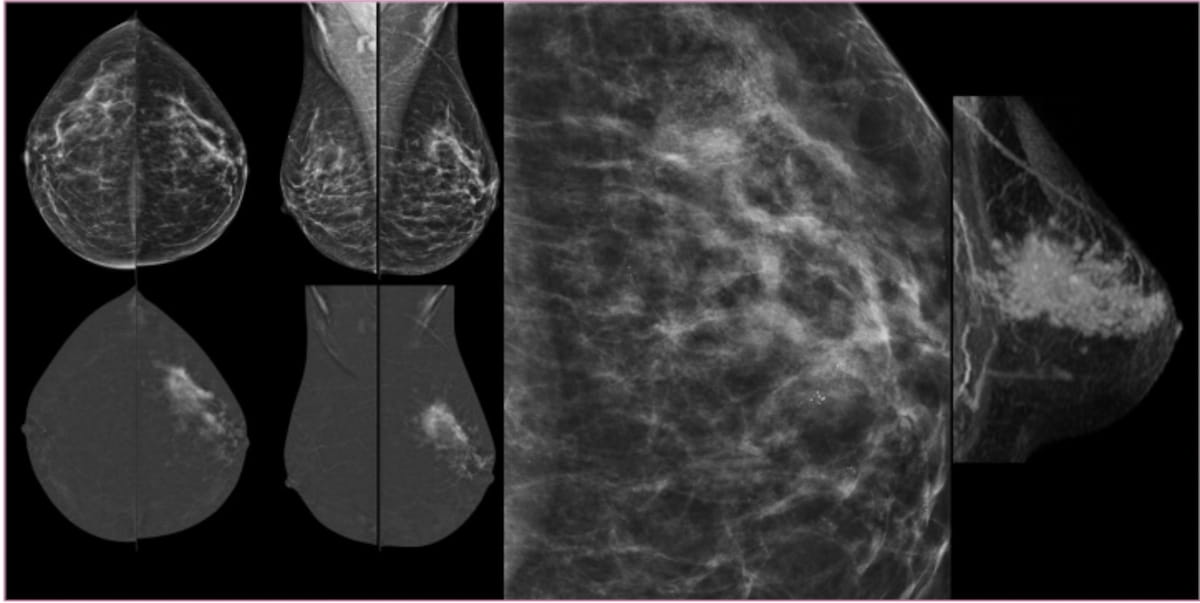 Is Contrast-Enhanced Mammography a Viable Option for Diagnosing Invasive Lobular Carcinoma?