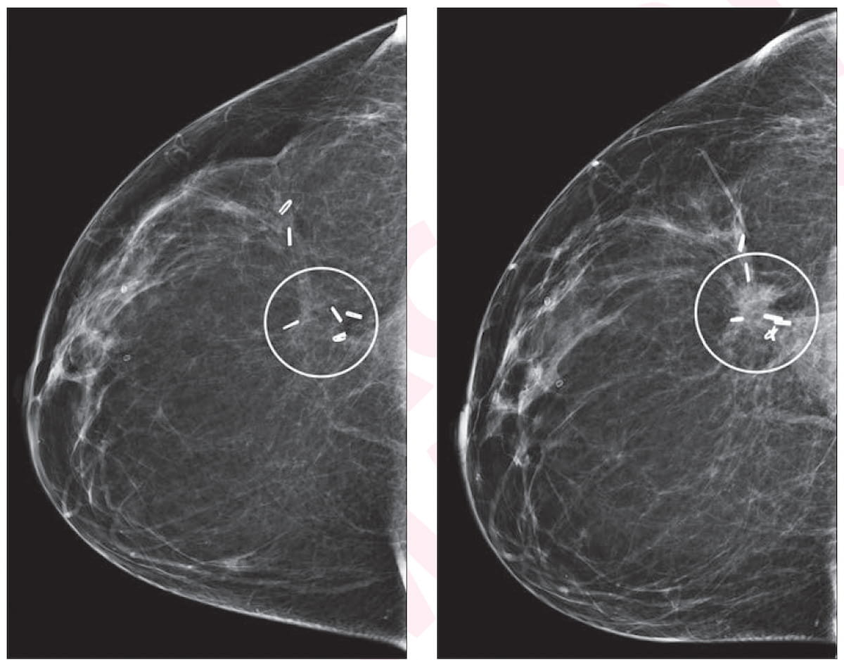 Mammography Surveillance: Can Screening DBT Have an Impact After Breast Cancer Treatment?