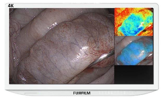 FDA Clears Fujifilm Endoscopy Imaging System