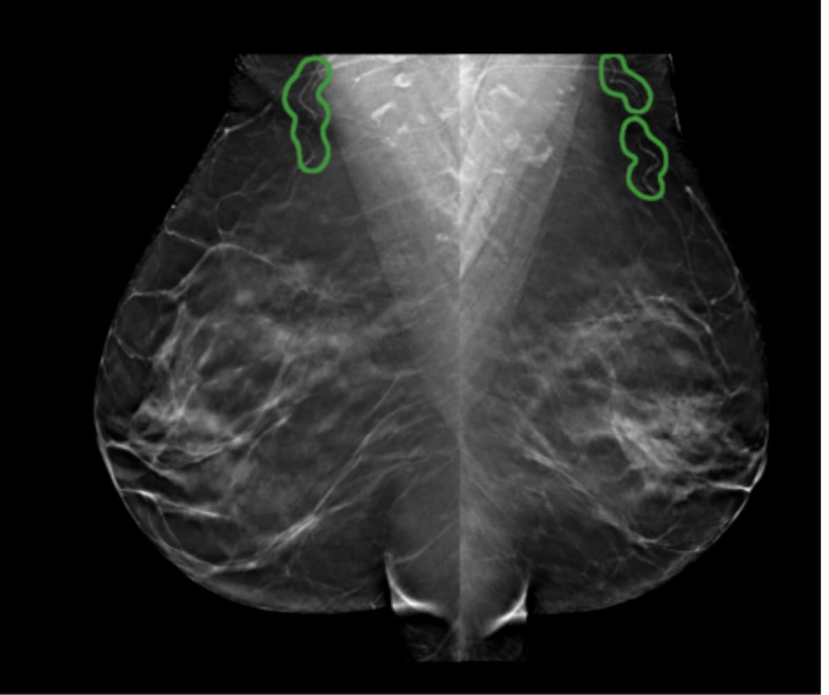 Mammography News: FDA Clears AI Software for Breast Arterial Calcification Detection