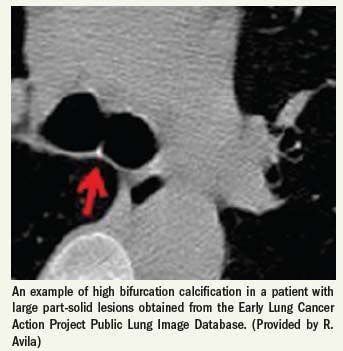 Combined pulmonary assessments produce lung cancer biomarker