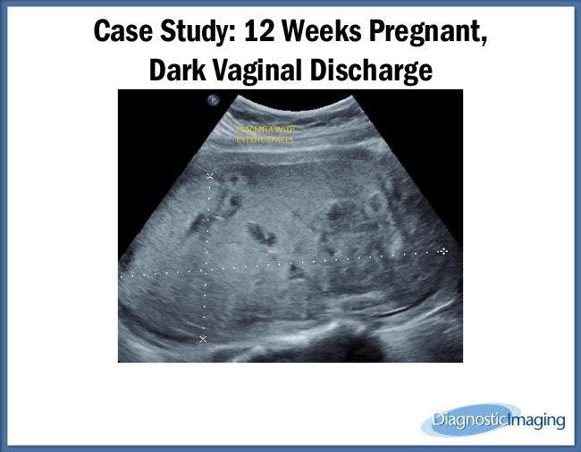 12 Weeks Pregnant, Dark Vaginal Discharge