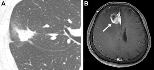 What a Chest CT Study Reveals About Ground-Glass Opacities and Recurrence with Lung Adenocarcinoma