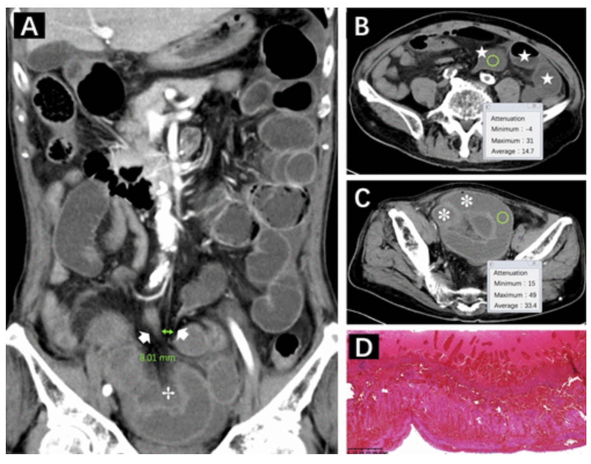 New Research Assesses Key CT Signs for Predicting Bowel Necrosis 