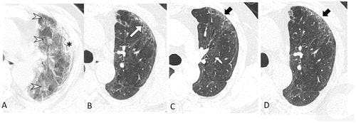 CT Study Reveals Persistent Lung Abnormalities Two Years After COVID-19
