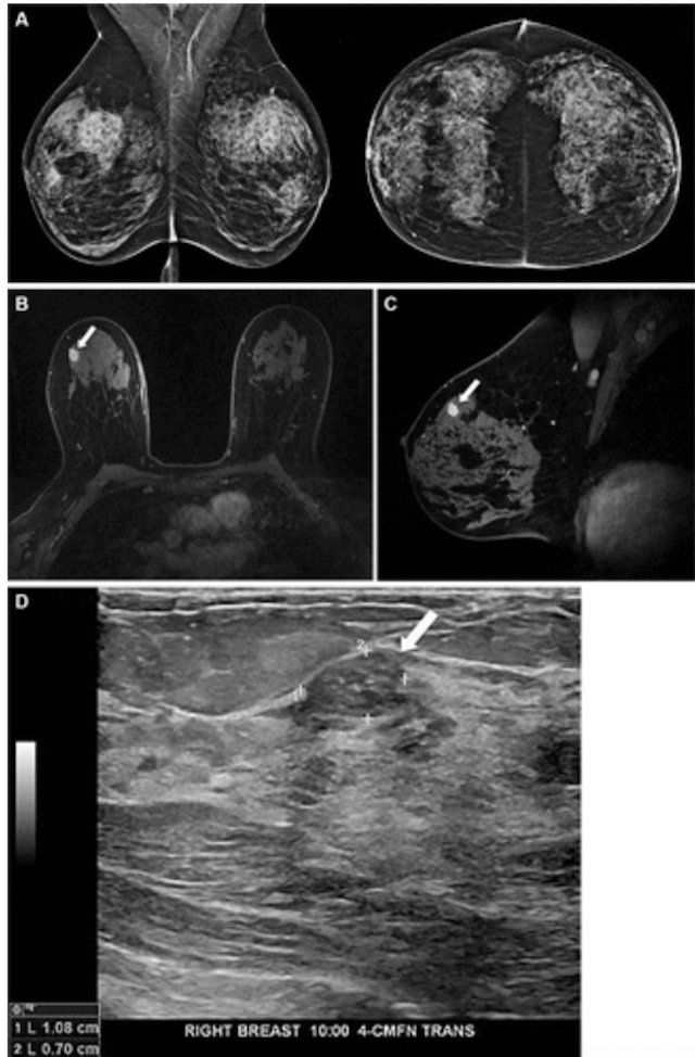Mammography-Based Deep Learning Model Facilitates Higher Breast Cancer Detection on Screening MRI 