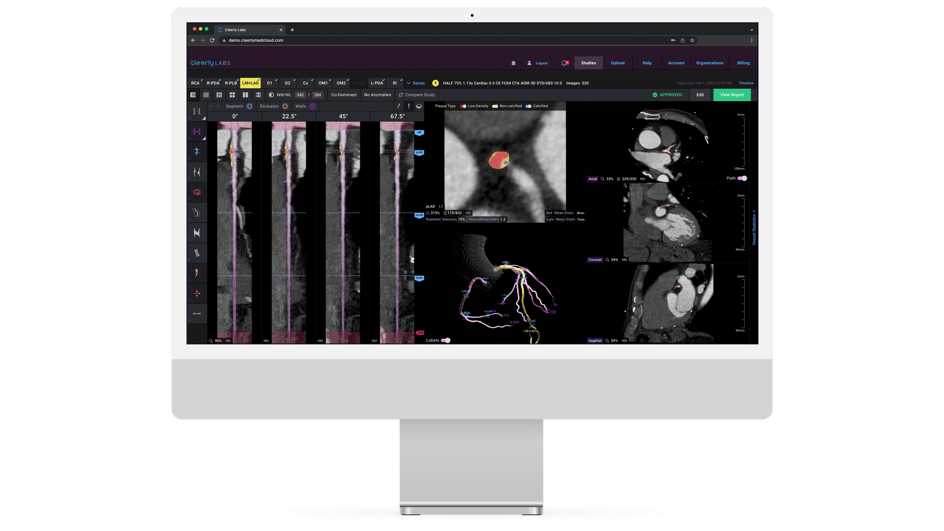 New Software Facilitates Use of Coronary CT Angiography Scans in Radiology Workflow