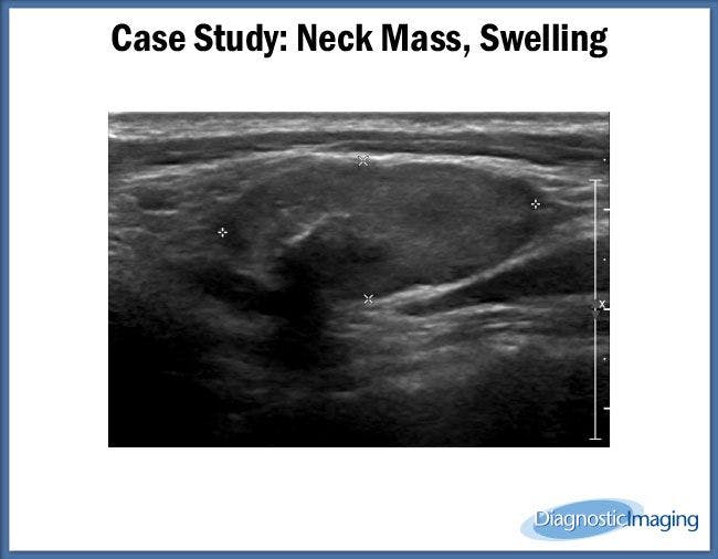 Neck Mass, Swelling
