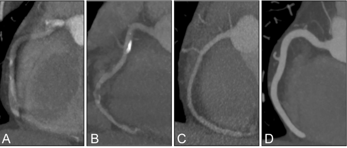 CT angiographs show representative grading of the image quality for the right coronary artery. A, Grade 1 (nondiagnostic); B, grade 2 (adequate); C, grade 3 (good); D, grade 4 (excellent).

Credit: RSNA