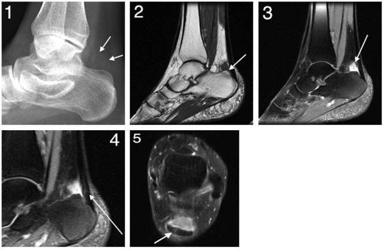 MRI reveals cause of heel pain