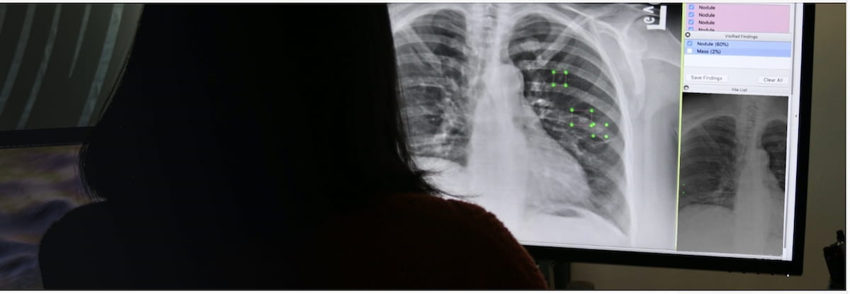 FDA Clears AI-Powered Software for Lung Nodule Detection on X-Rays