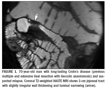 MR imaging features combineto classify Crohn's disease
