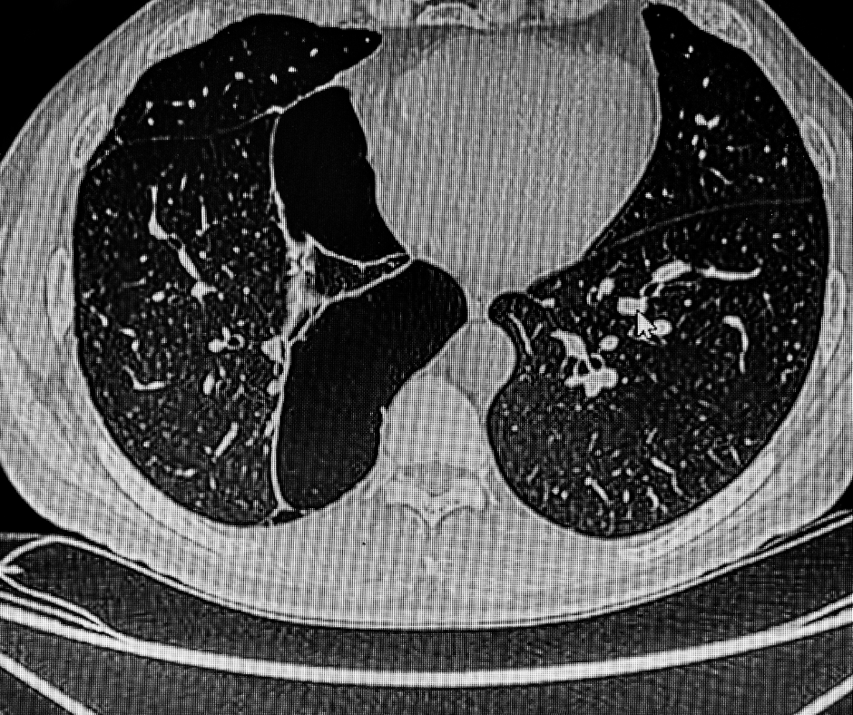 What a Ten-Year CT Study Reveals About Emphysema and Continued Smoking