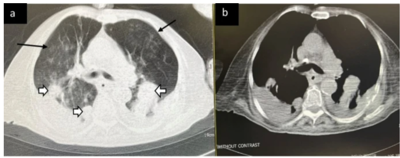 COVID-19 and Cancer: What a New Chest CT Study Reveals