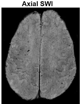 Image IQ: 65-year old female, Altered Mental Status, SIRS