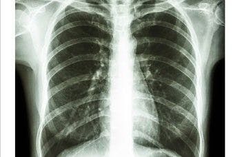 GE Healthcare AI Suite Pinpoints Chest X-ray Abnormalities