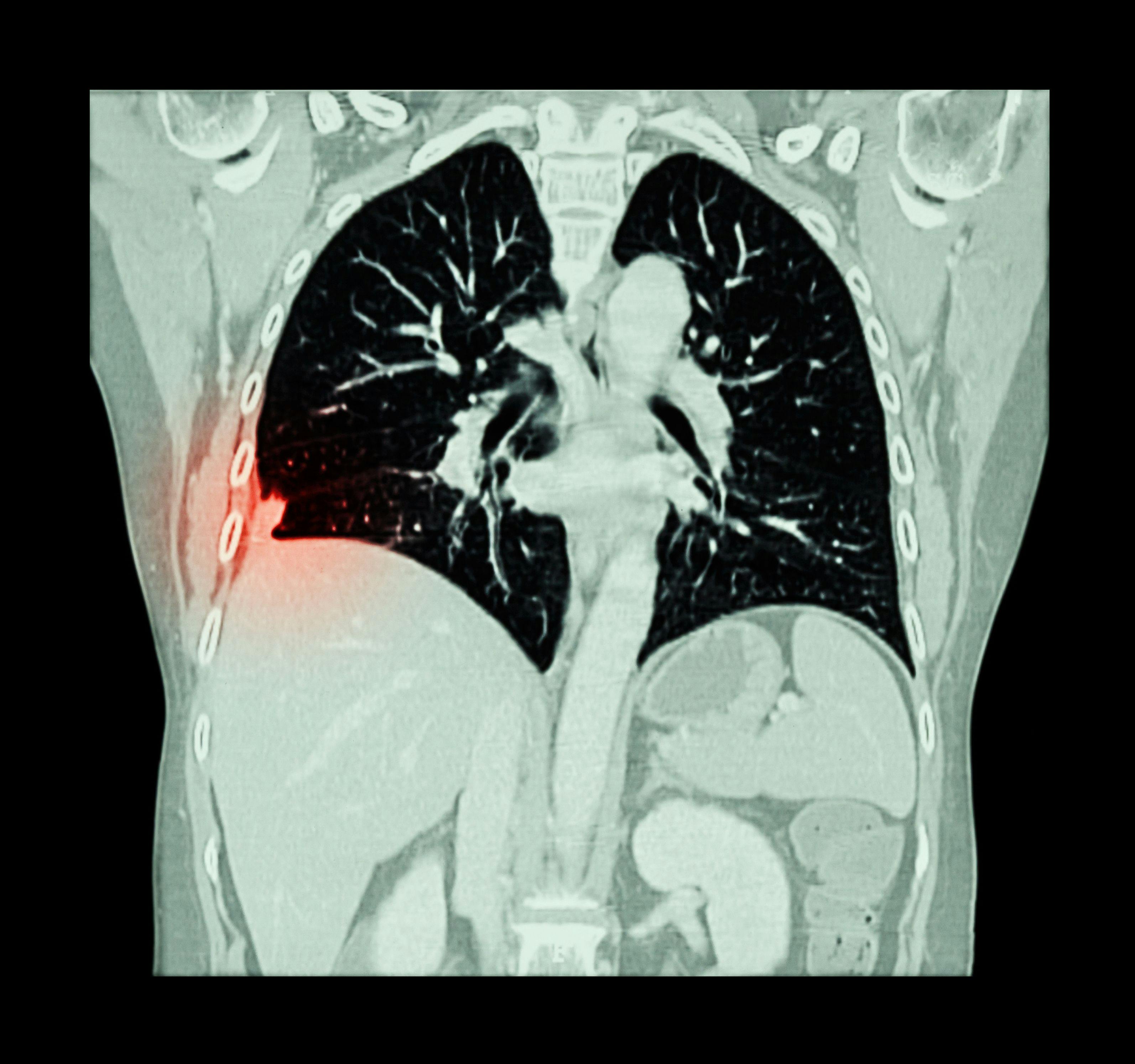 Community-Based Intervention May Increase Lung Cancer Screening 