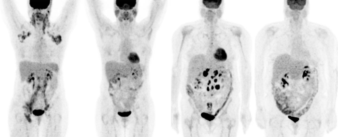 SNM: Image of the Year shows radioimmunotherapy’s effectiveness against non-Hodgkin’s lymphoma