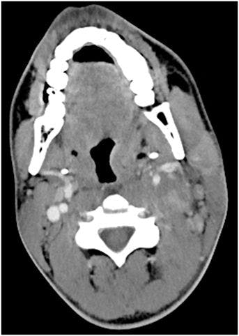 Image IQ: 20-year-old Male, Left Neck Pain